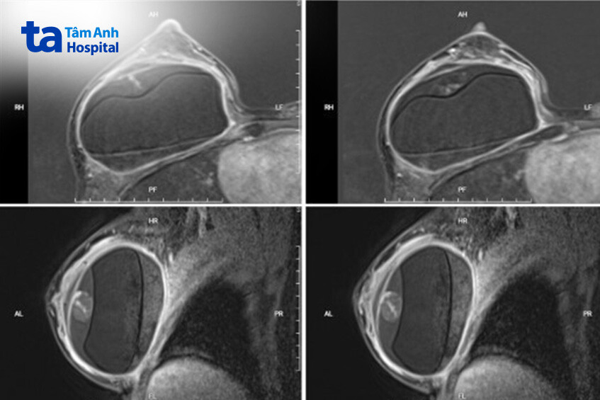 hình chụp mri của bệnh nhân