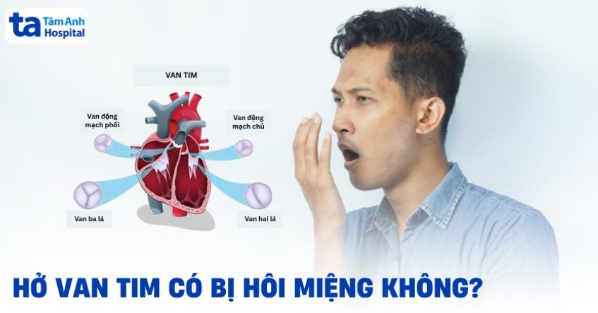 Bị hở van tim có bị hôi miệng không? Có đáng lo không?