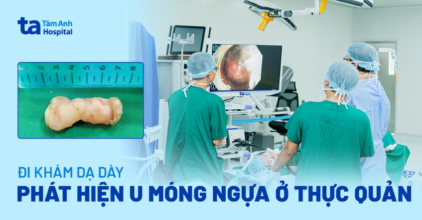 Đi khám dạ dày phát hiện u móng ngựa ở thực quản