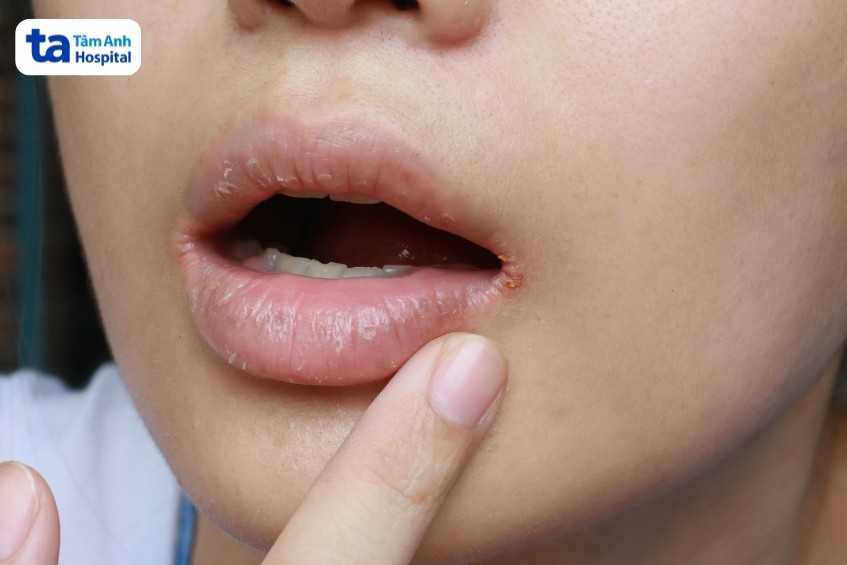 khô miệng là tác dụng phụ có thể gặp ở người bệnh được xạ trị