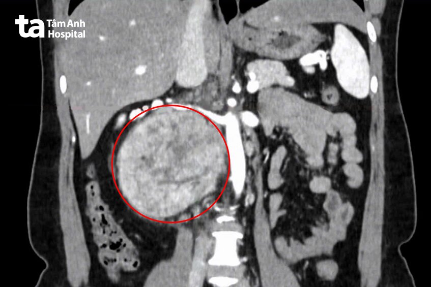 khối u khổng lồ sau phúc mạc
