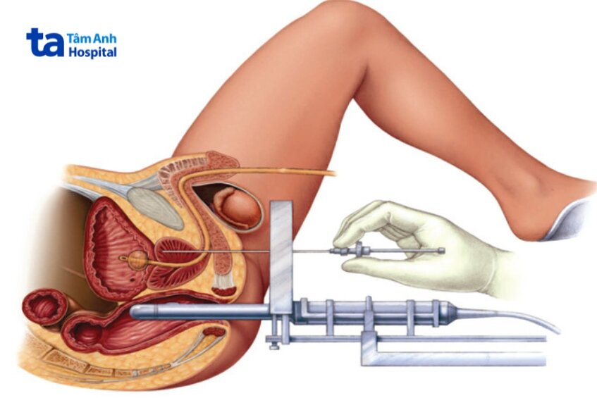 kỹ thuật xạ trị áp sát xuyên mô