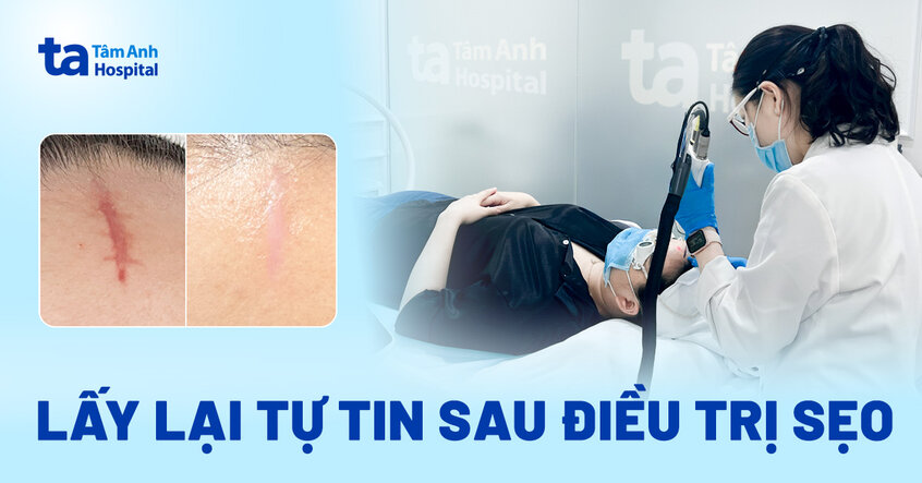 Lấy lại tự tin sau điều trị sẹo