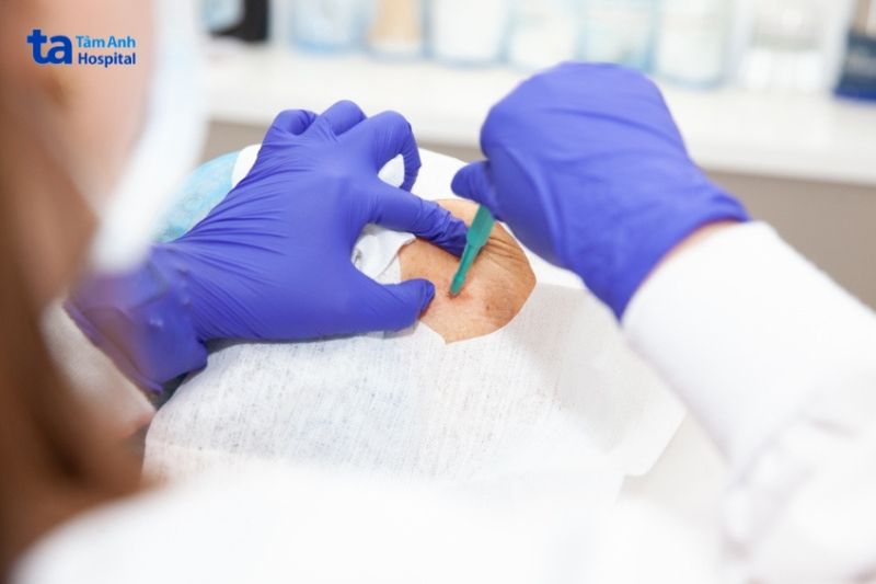 Xét Nghiệm Vảy Nến Gồm Những Phương Pháp Gì? Sinh Thiết Da Để Xét Nghiệm Bệnh