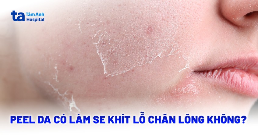 Lỗ chân lông to có nên peel da không?