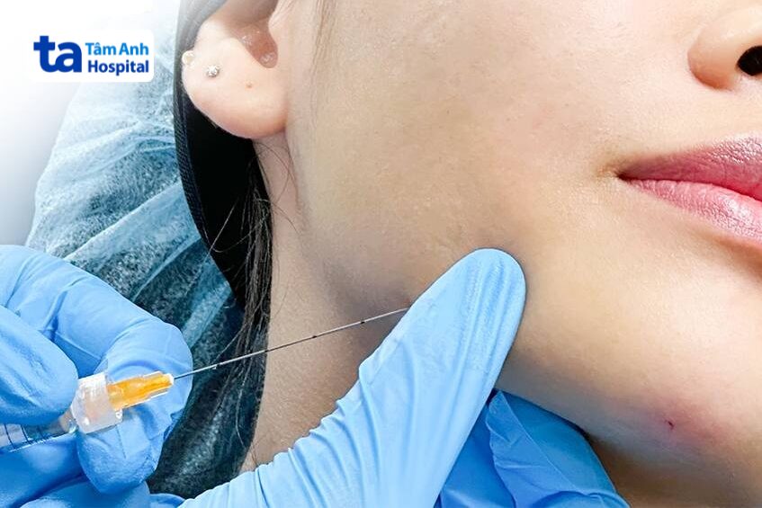 Mặt Lệch Có Tiêm Filler Được Không? Lợi Ích Khi Tiêm Filler Chỉnh Mặt Lệch