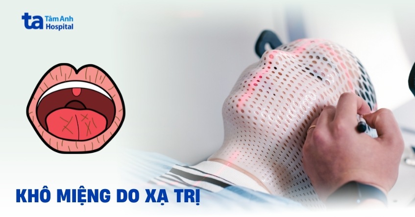 Lý do vì sao lại bị khô miệng do xạ trị?