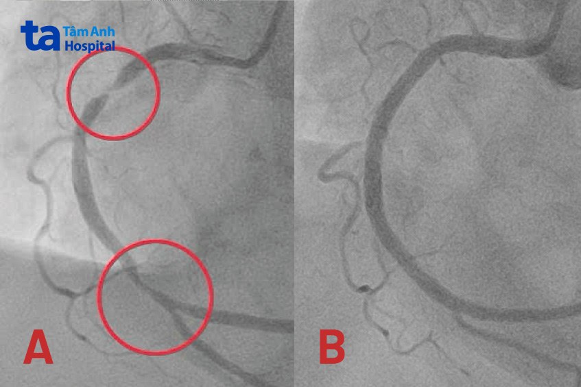 Mạch vành phải hẹp nặng nhiều chỗ (hình A) và sau khi được can thiệp tái thông (hình B)