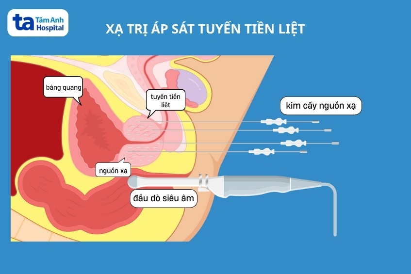 minh họa xạ trị áp sát liều cao điều trị ung thư tuyến tiền liệt