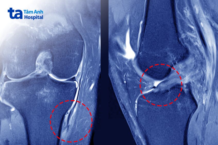 mri đứt dây chằng chéo trước và bên trong
