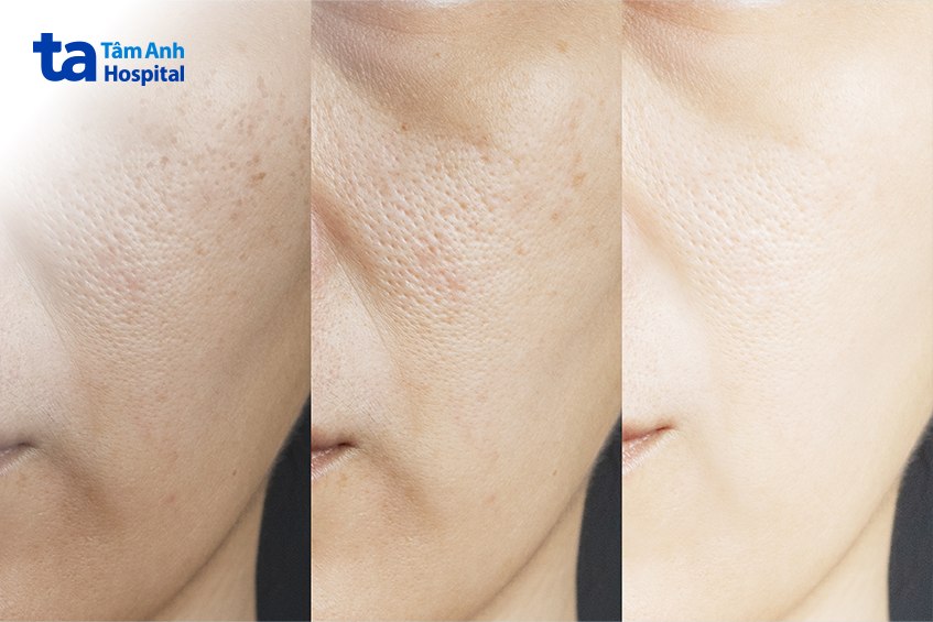 Lỗ Chân Lông To Có Nên Peel Da Không? Mức Độ Hiệu Quả Đạt Được