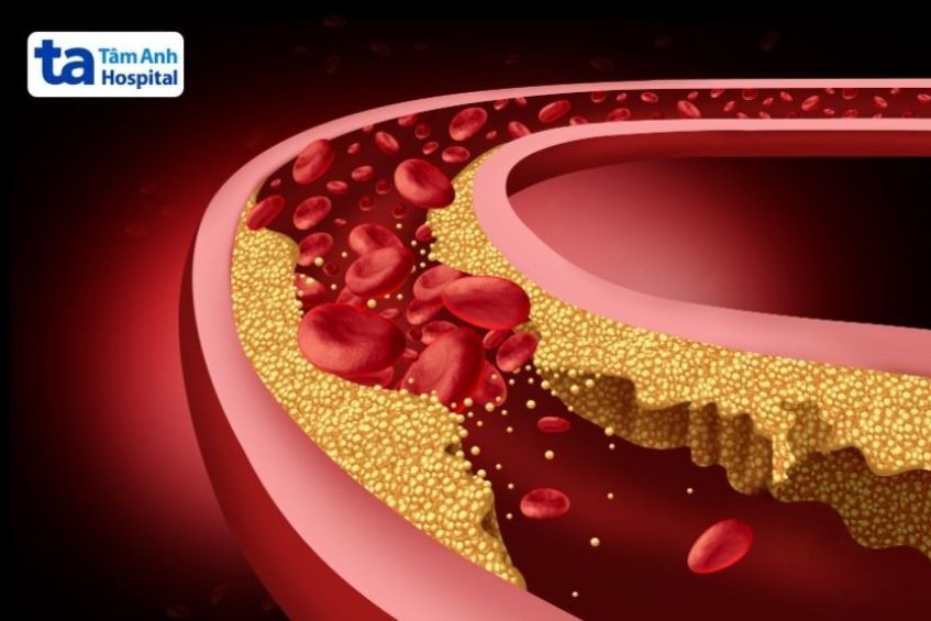 Công Thức Tính Ldl Khi Triglycerid Cao Và Cách Áp Dụng Đúng Triglyceride Cao Làm Tăng Nguy Cơ Xơ Vữa Động Mạch
