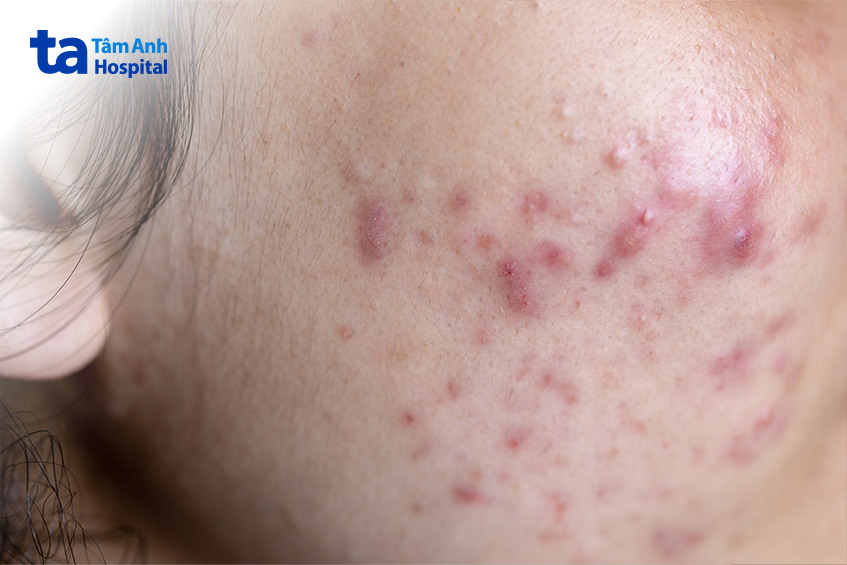 nguyên nhân gây tăng tắc tố da