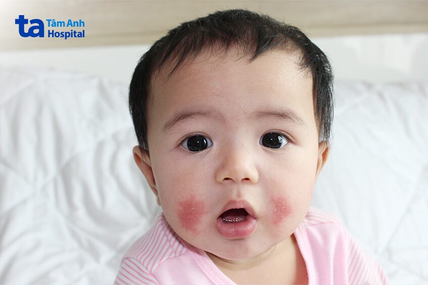 nguyên nhân rối loạn sắc tố da bẩm sinh