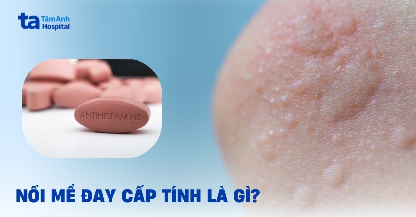 Triệu chứng nổi mề đay cấp tính và cách xử lý an toàn