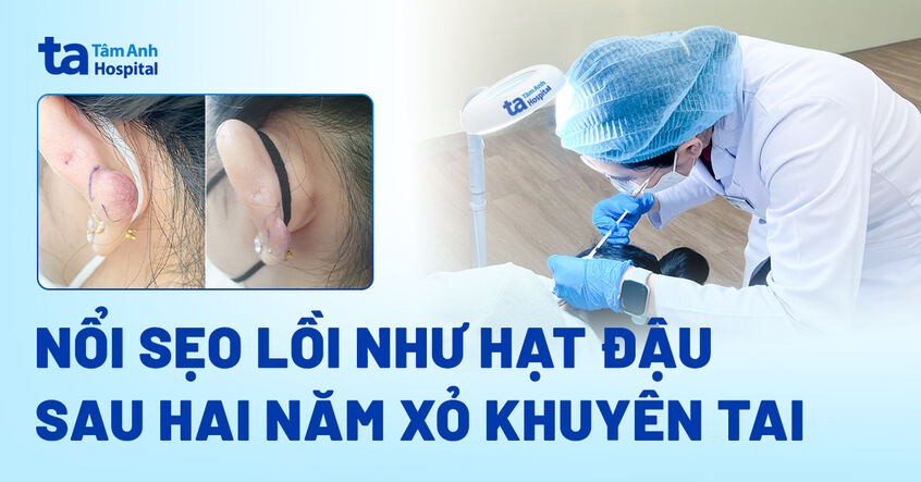 Nổi sẹo lồi như hạt đậu sau hai năm xỏ khuyên tai