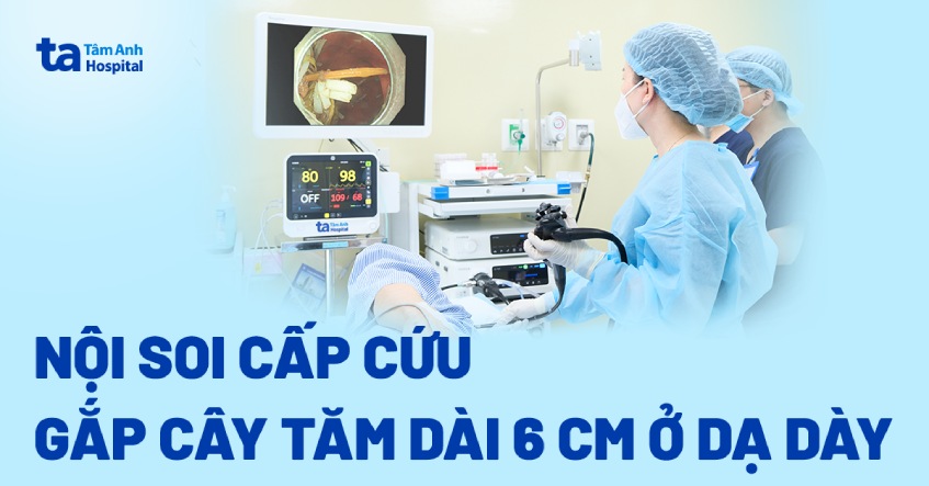 Nội soi cấp cứu gắp cây tăm dài 6 cm ở dạ dày