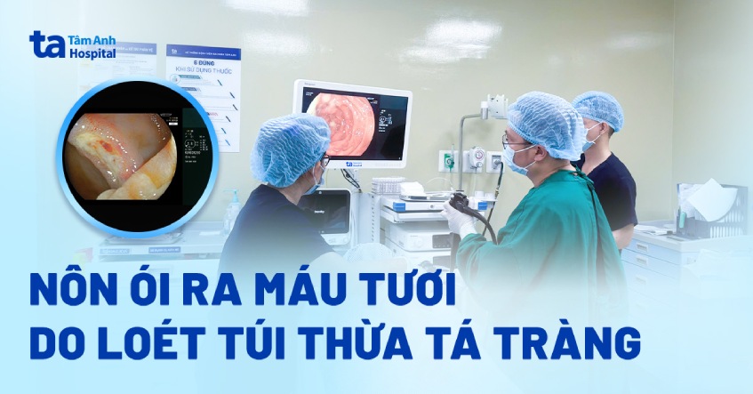 Nôn ói ra máu tươi do loét túi thừa tá tràng