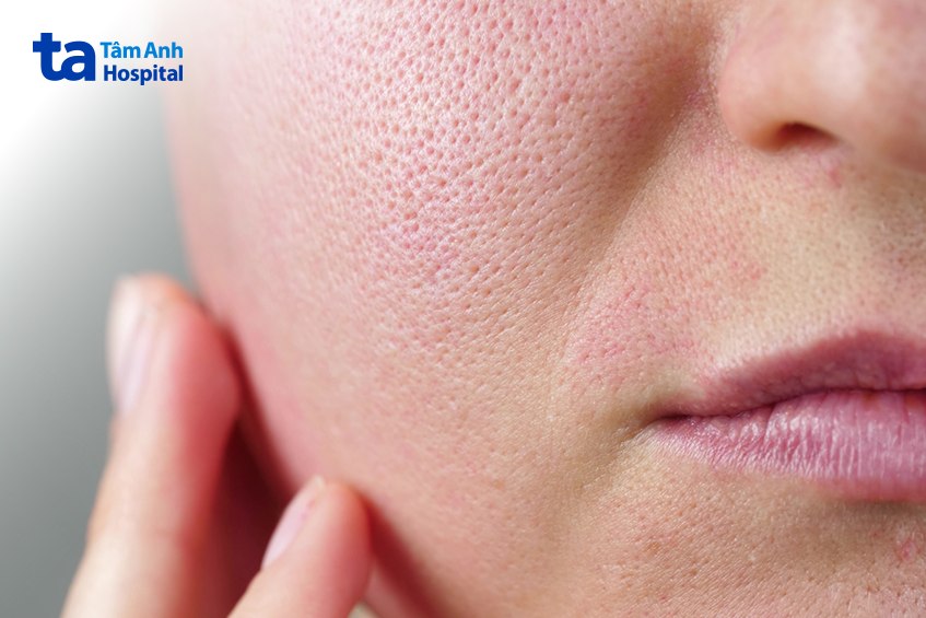 Lỗ Chân Lông To Có Nên Peel Da Không? Peel Da Thu Nhỏ Lỗ Chân Lông To