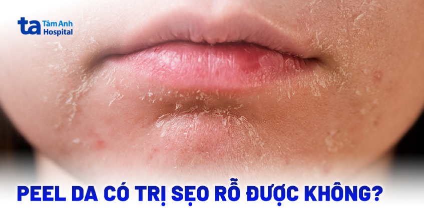 Peel da trị sẹo rỗ được không? Mức độ nào có thể thử?