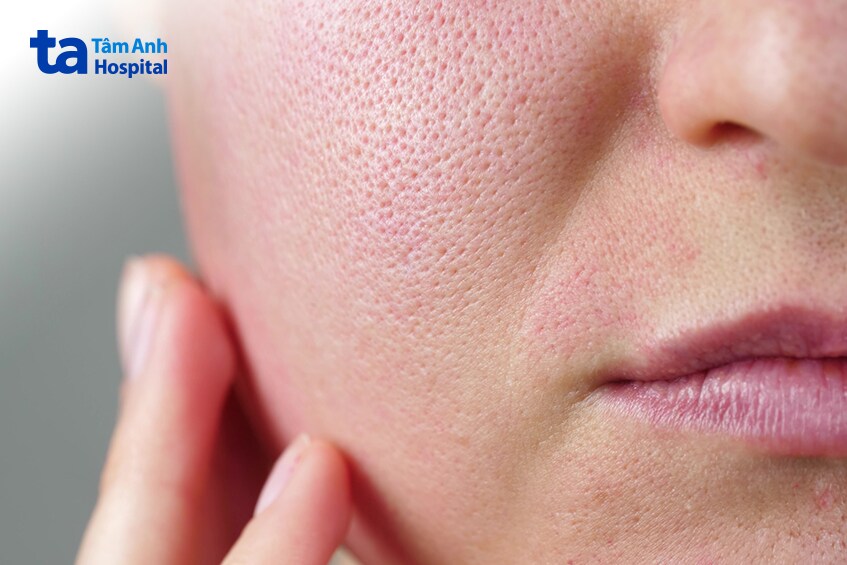 peel trị sẹo rỗ phù hợp với ai