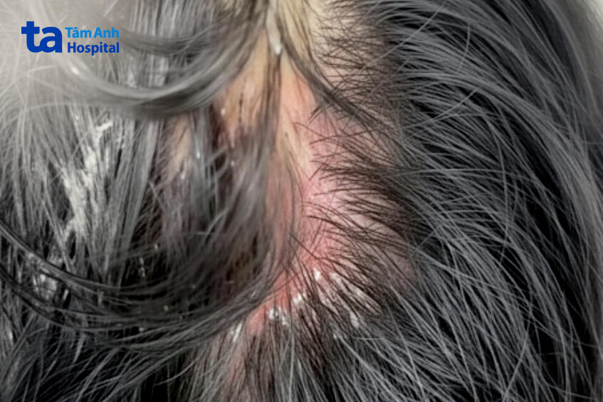 phần da đầu bị bỏng