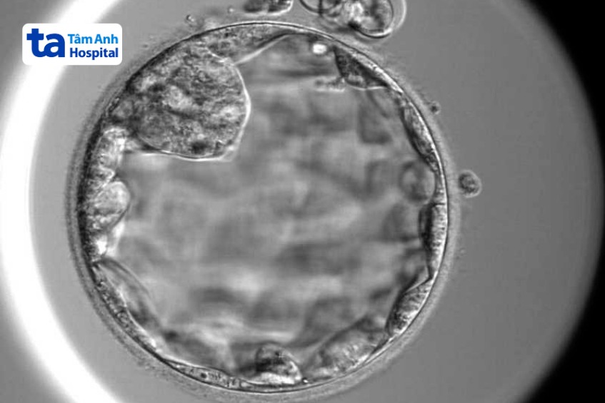 Hình ảnh phôi ngày 5 được nuôi cấy tại IVF Tâm Anh TP.HCM