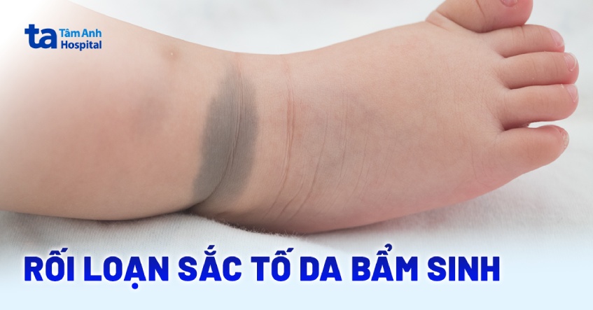 Hiện tượng rối loạn sắc tố da bẩm sinh và điều ba mẹ quan tâm