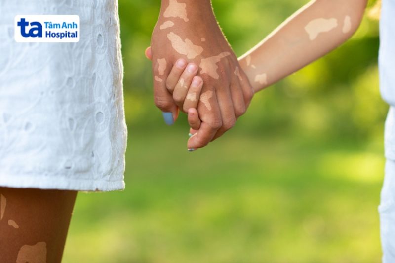 rối loạn sắc tố da ở bé do di truyền