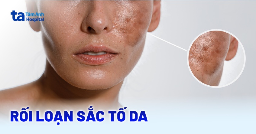 Rối loạn sắc tố da và cách điều trị hiệu quả