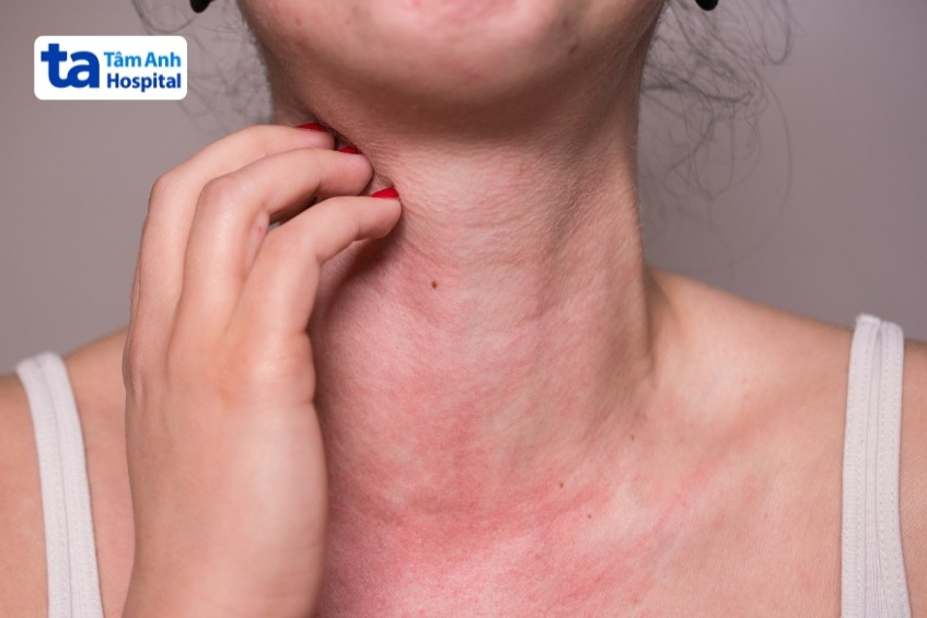 Giải Đáp Nhanh: Nổi Mề Đay Có Nên Bôi Dầu Gió Không? Rủi Ro Khi Sức Dầu Giảm Ngứa Mày Đay