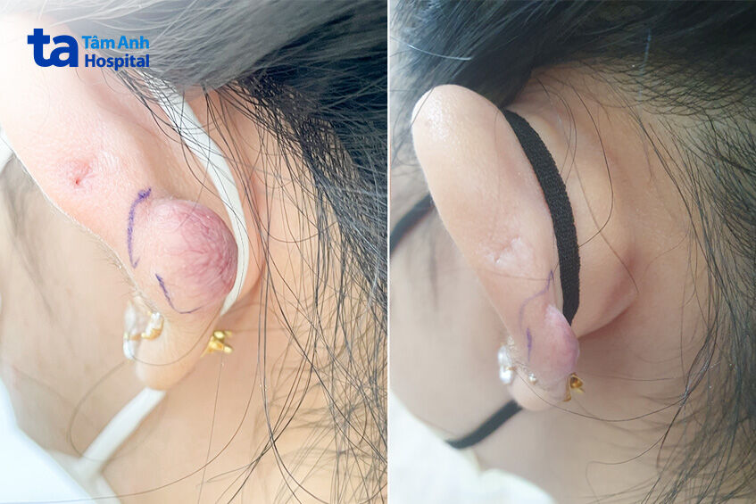 sẹo lồi đã được thu gọn sau 4 lần tiêm