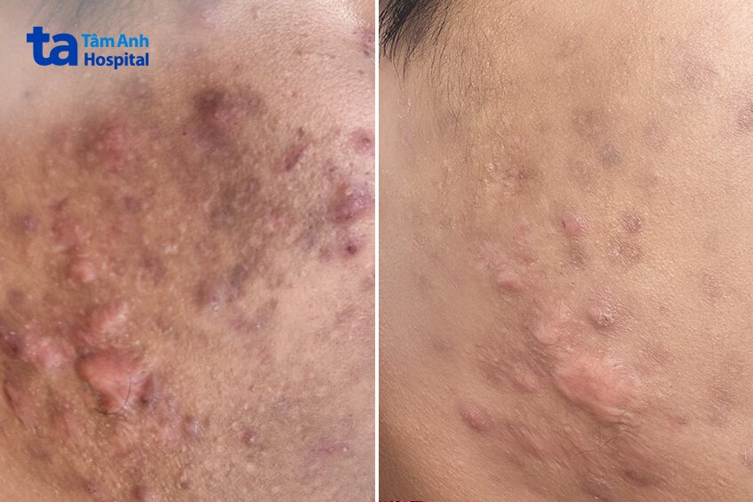 sẹo mụn trước và sau khi điều trị