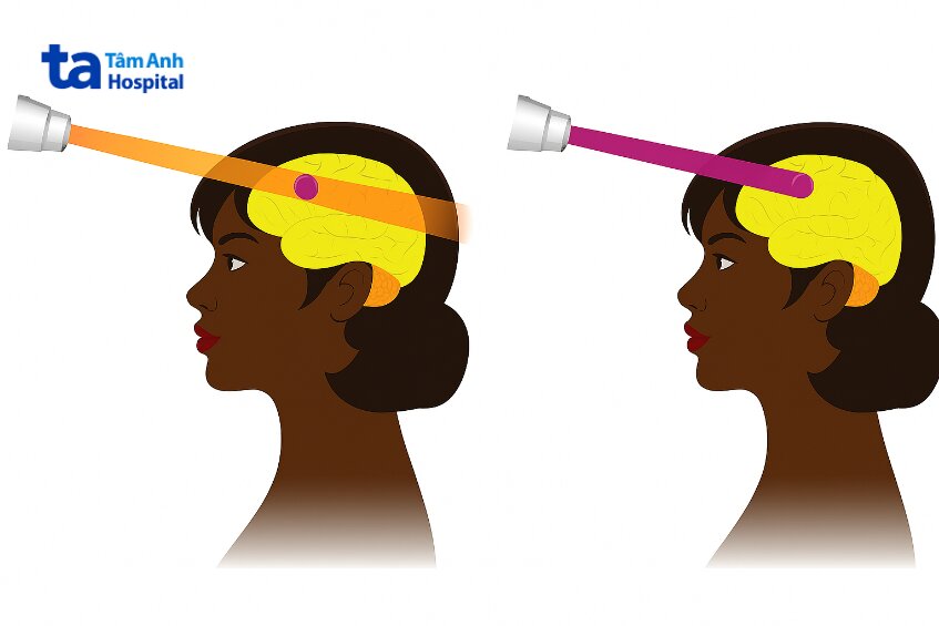 so sánh phương pháp xạ trị bằng tia x và proton