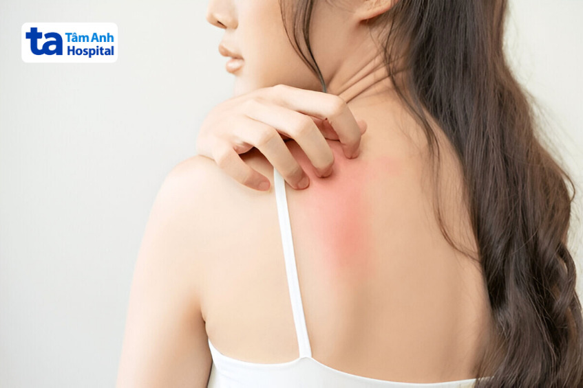 Peel Lưng Và Những Lợi Ích Nổi Bật Tác Dụng Phụ Khi Peel Lưng Có Thể Gặp