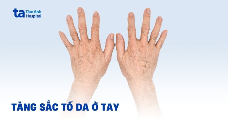 Tăng sắc tố da ở tay: Hiểu đúng để xử lý sớm