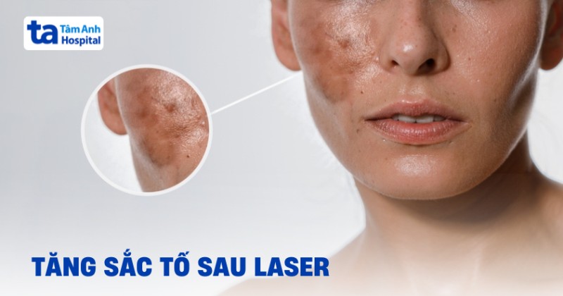 Hiện tượng tăng sắc tố sau laser phải làm sao?