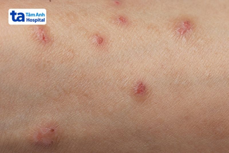 da bị viêm mủ dễ bị tăng sắc tố