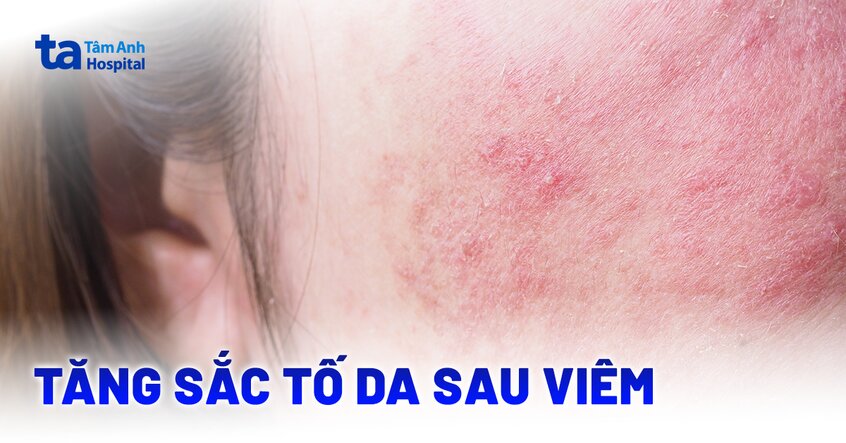 Vì sao lại tăng sắc tố sau viêm? Đâu là giải pháp?