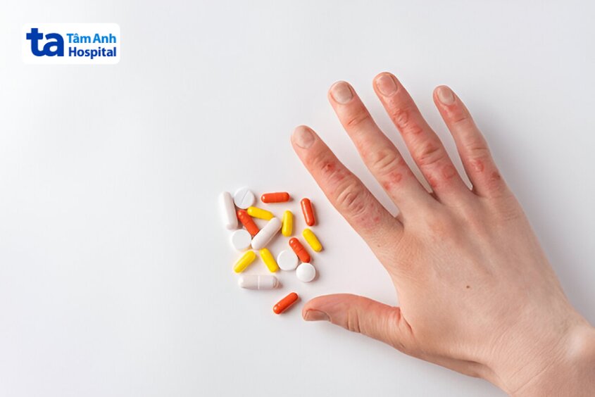thuốc uống điều trị vảy nến