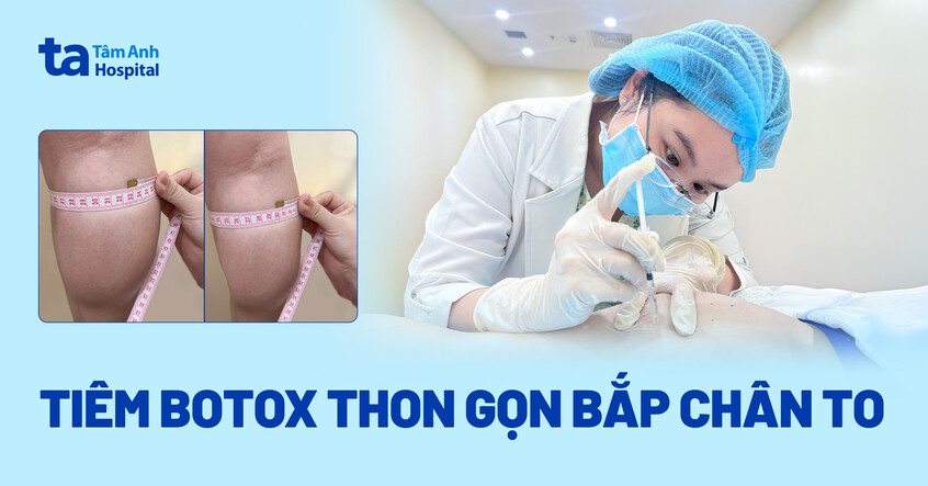 Tiêm botox thon gọn bắp chân to
