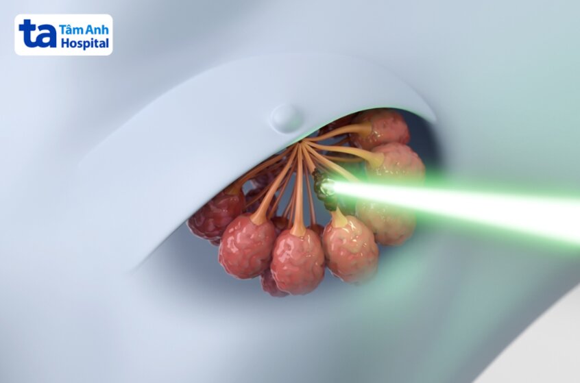 tiêu diệt hoặc làm tổn thương dna tế bào ung thư