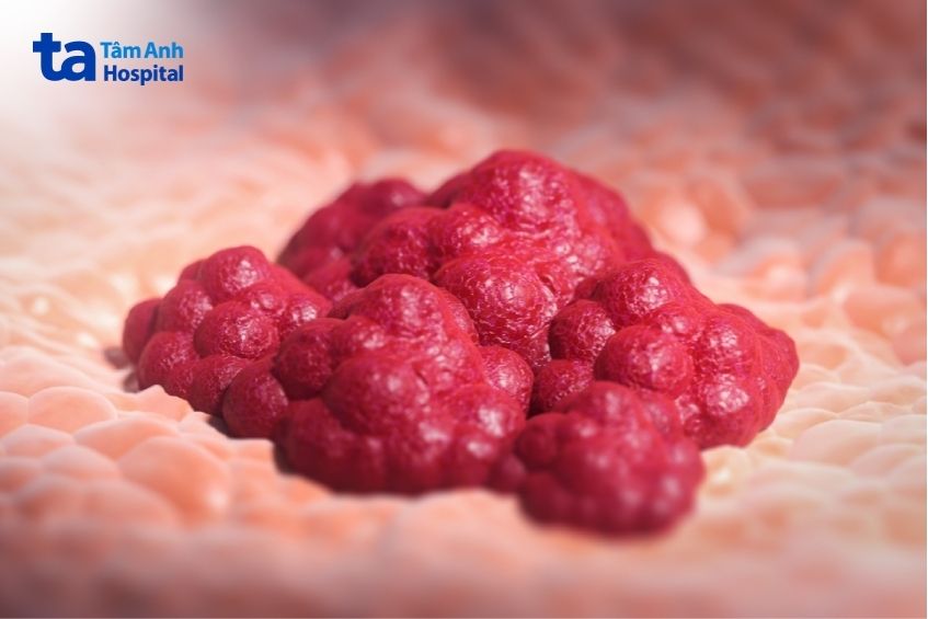 tùy loại u sẽ có cách điều trị khác nhau