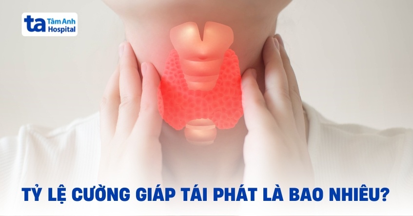 Tỷ lệ cường giáp tái phát là bao nhiêu?