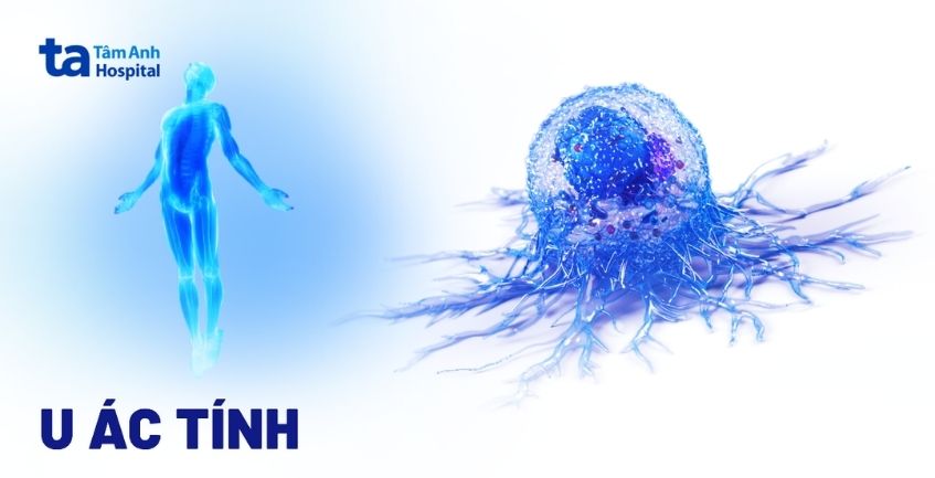 Toàn bộ kiến thức cần biết về u ác tính