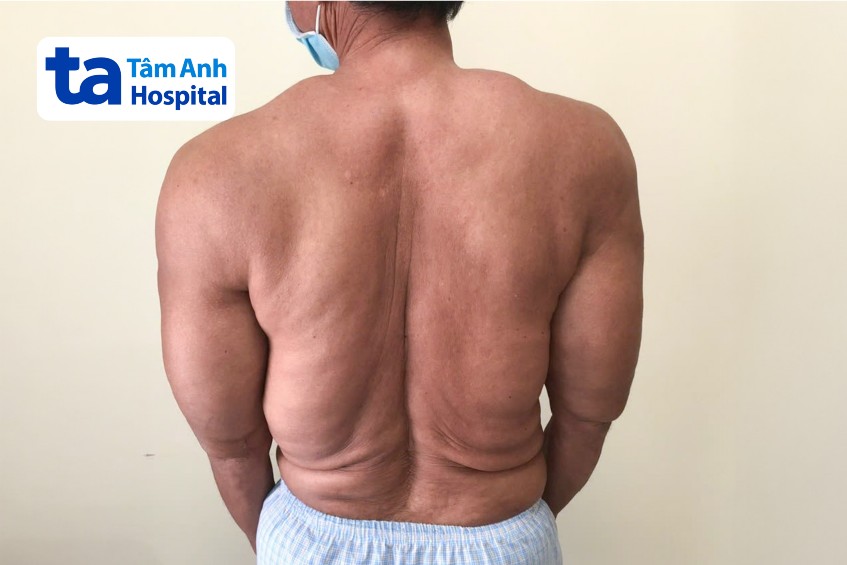 u mỡ làm cơ thể sưng to bất thường