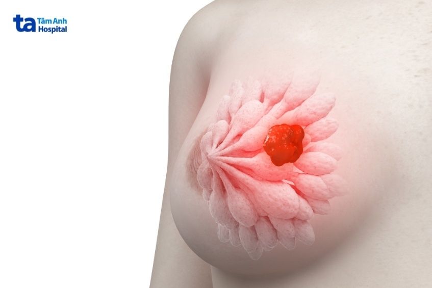 ung thư vú có tiên lượng khá tốt