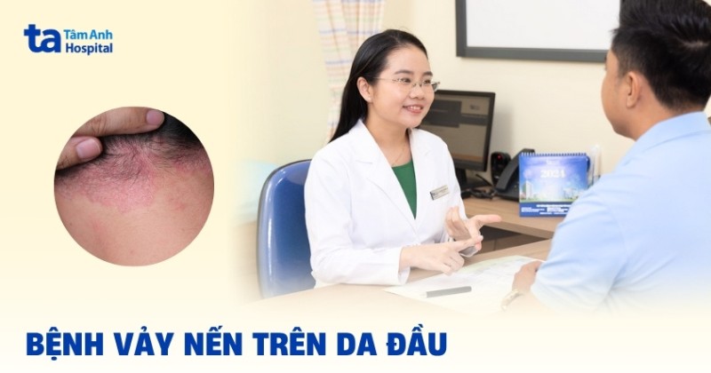 Vảy nến da đầu và những điểm cần lưu tâm