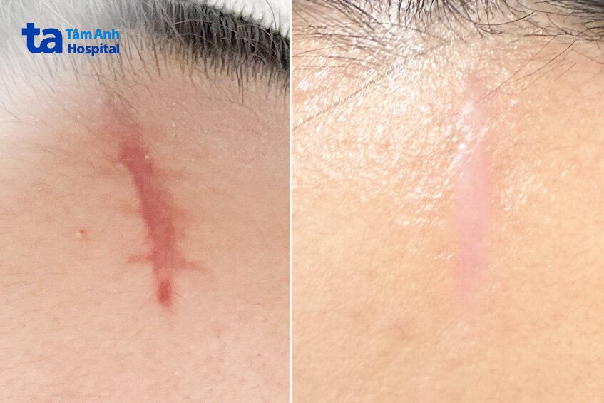 vết sẹo mờ hẳn sau điều trị