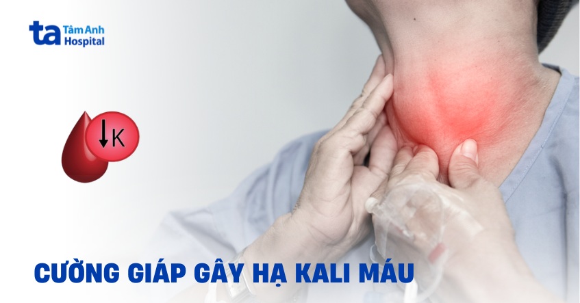 Vì sao cường giáp gây hạ kali máu? Giải pháp nào để kiểm soát?
